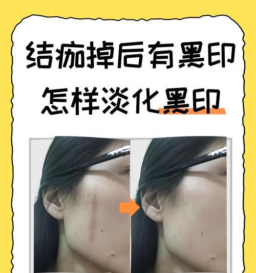 手指被洗衣机搅伤后应使用哪种药物？
